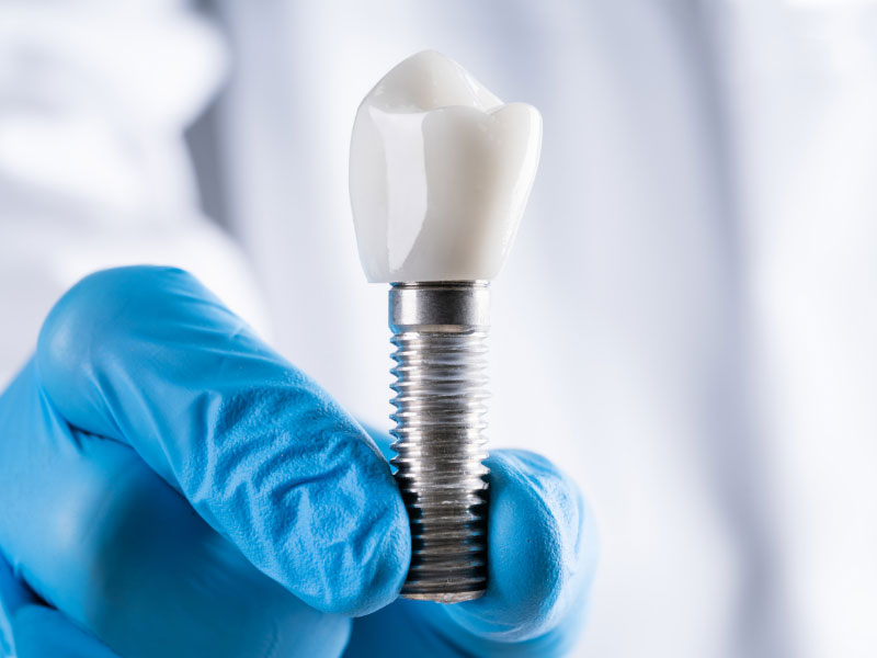 Dental Implants