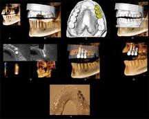 CT-Guided Surgery