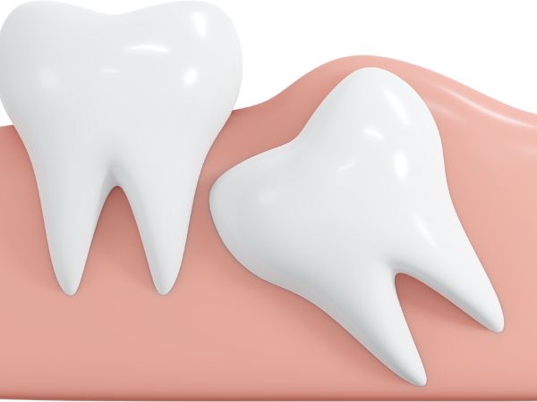 wisdom teeth