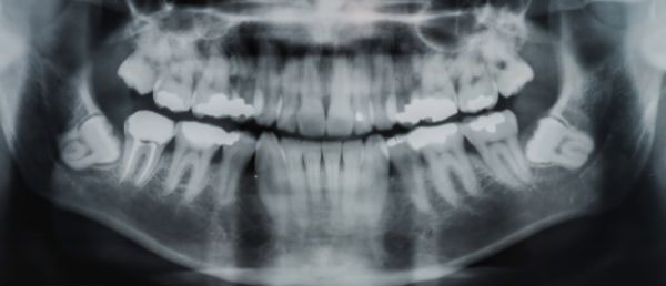 wisdom teeth